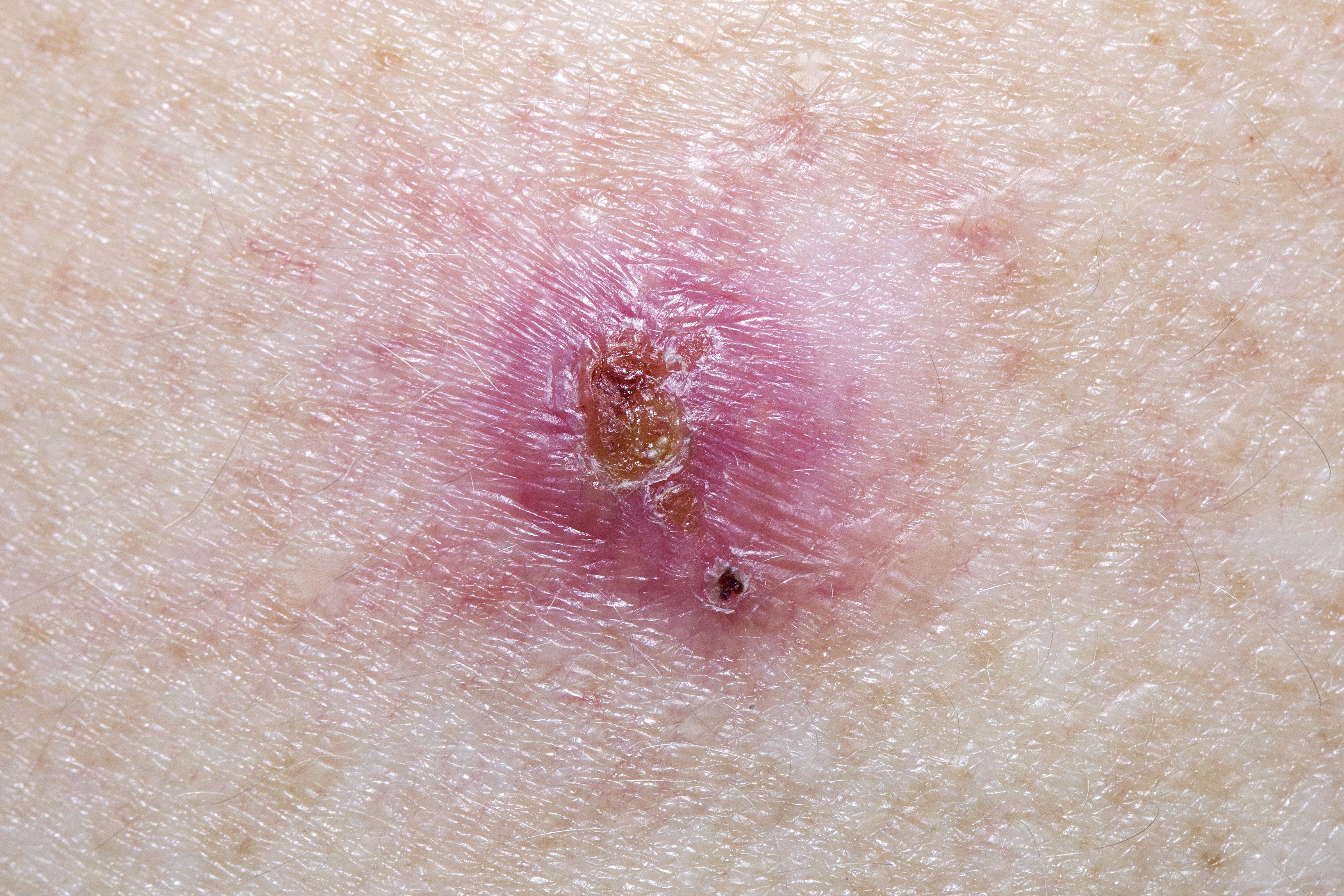 basal cell carcinoma