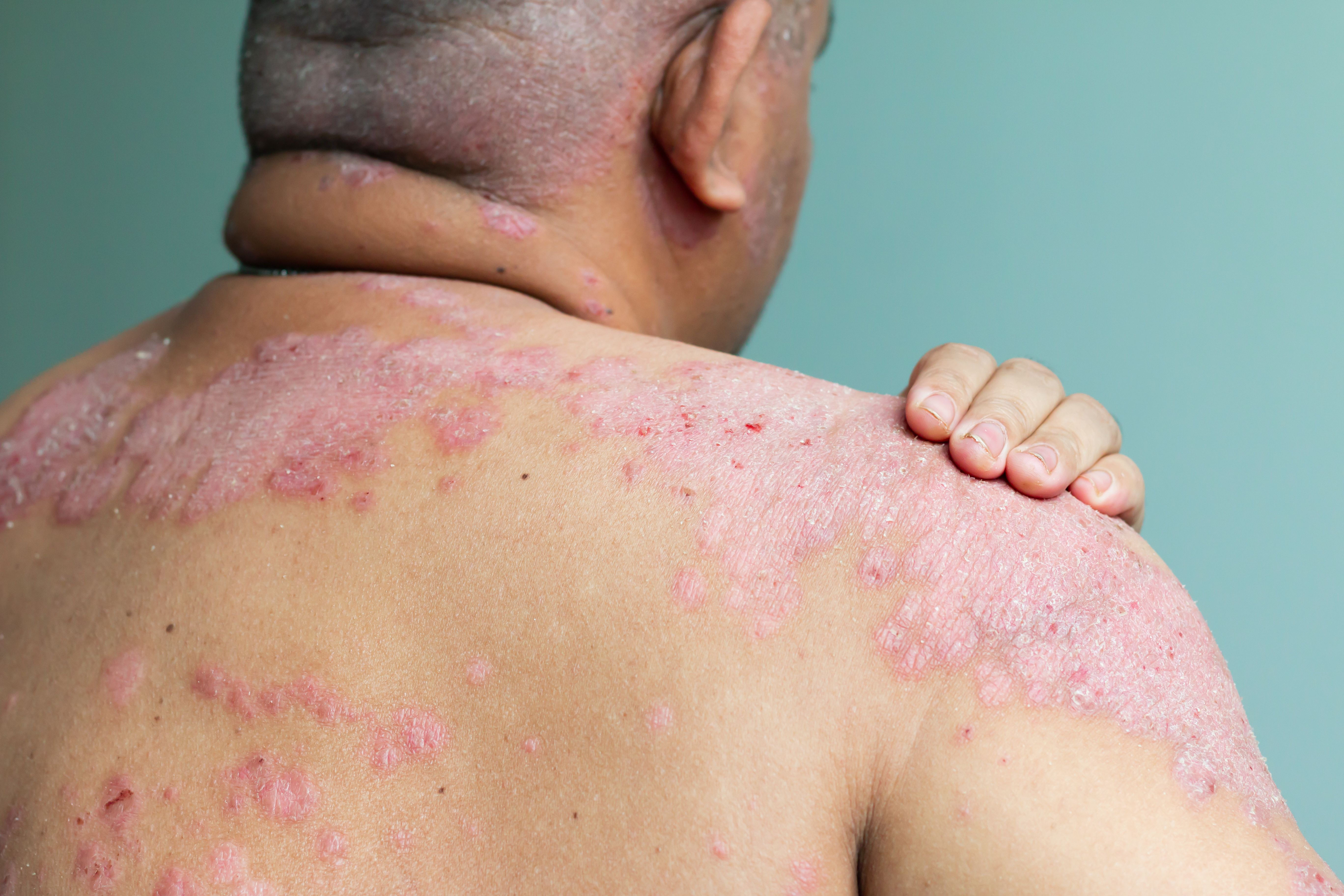 SB5 is Effective and Safe for Long-Term Psoriasis Treatment