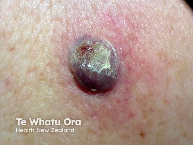 Nemvaleukin Alfa Demonstrates Durable Disease Control in Advanced Melanoma and RCC