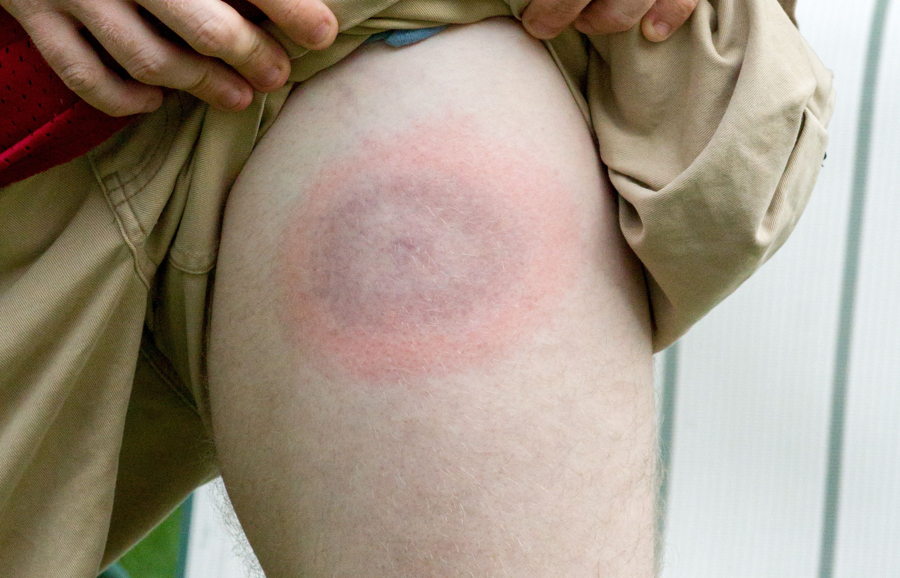 infectious disease