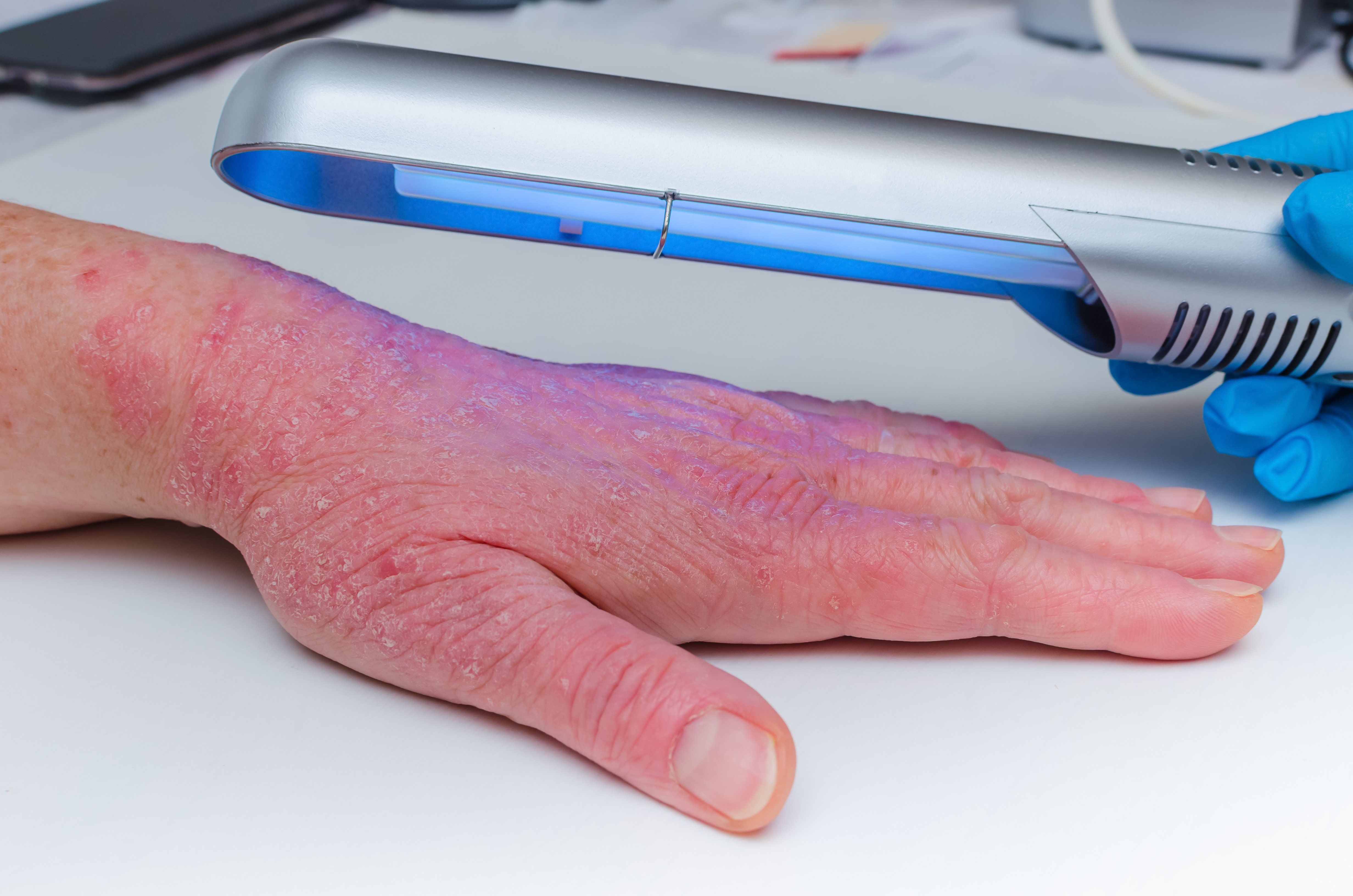 patient with psoriasis receiving phototherapy treatment 