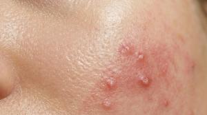 Dr. Charrow Highlights Earlier Biologic Use and Deroofing in Hidradenitis Suppurativa