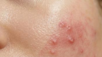 Dr. Charrow Highlights Earlier Biologic Use and Deroofing in Hidradenitis Suppurativa
