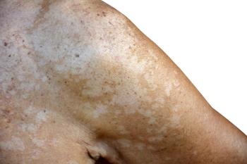 Hypopigmented skin