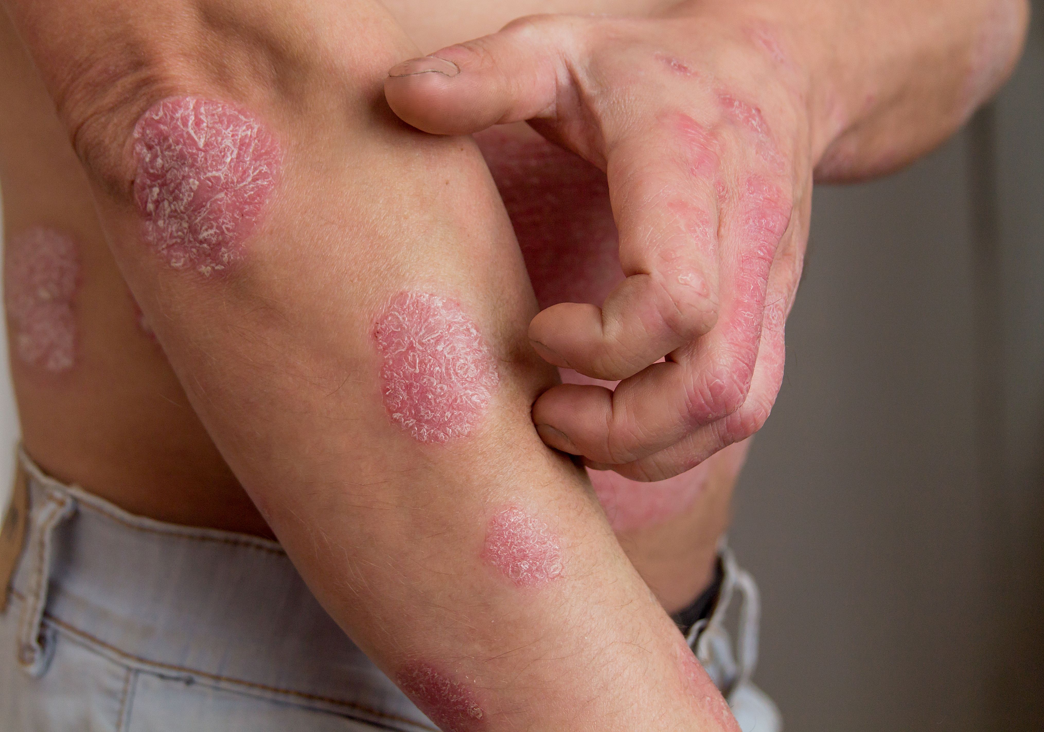 Oral TNFR1 Inhibitor Balinatumab Shows Promise in Psoriasis