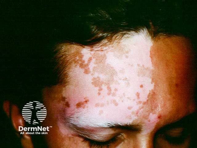 Vitiligo's Deep Impact on Life Choices