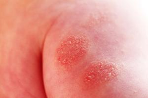 Interim Analysis Leads to Early Termination of DUPLEX-AD Study