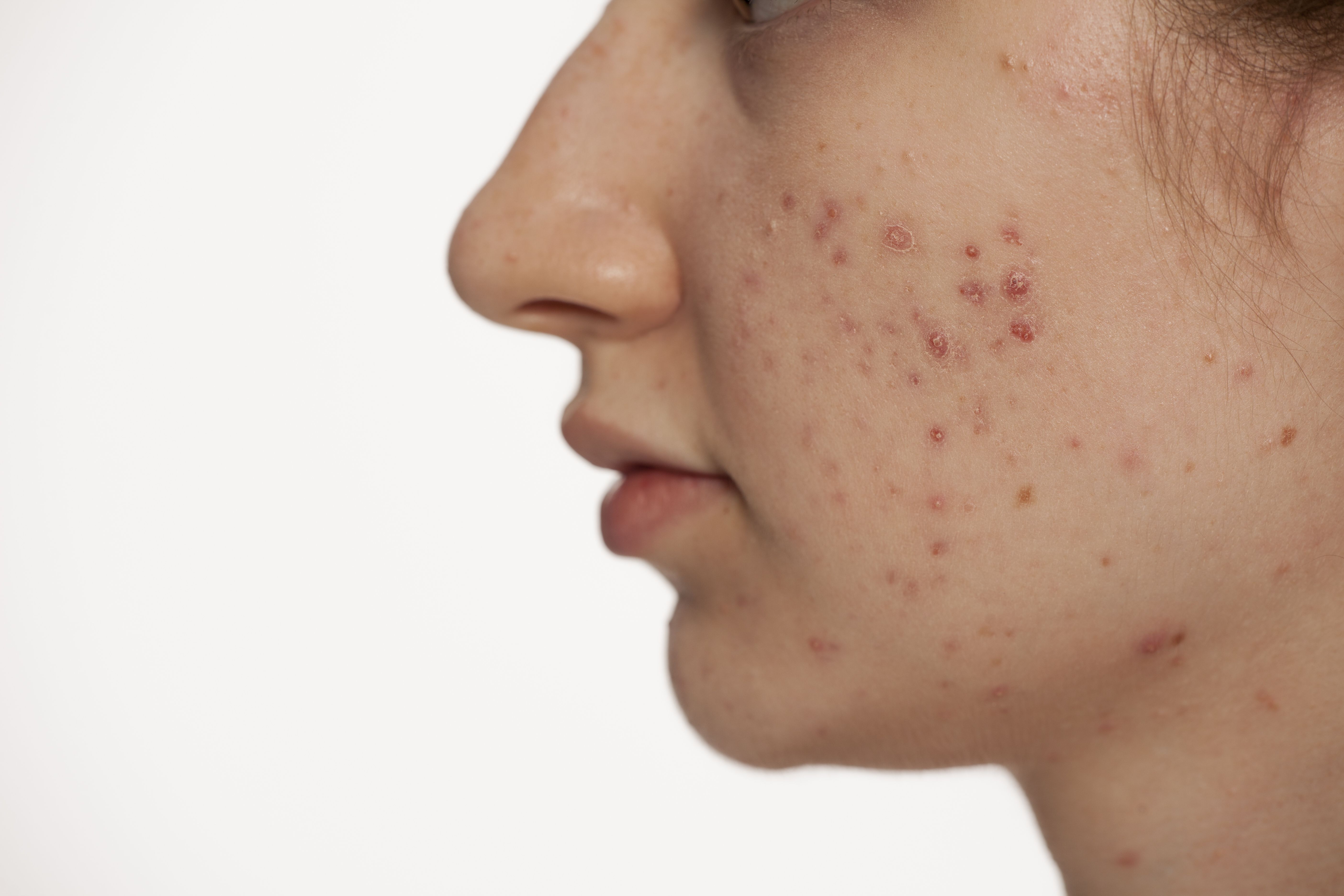 Get to the Roots of Pediatric Acne