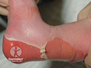 Abeona Initiates First Commercial Treatment of Zevaskyn for RDEB