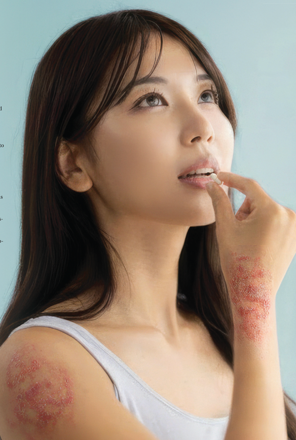 The Emerging Role of Oral Peptide Therapeutics in Psoriasis and Beyond