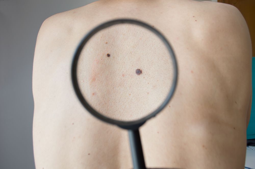 mole on back magnifying glass