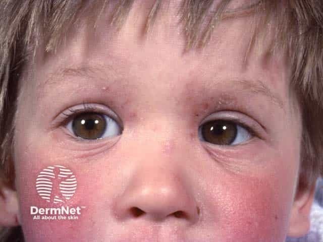 Pediatric Patients with Atopic Dermatitis Have Lower SCH and Higher TEWL, Compared to Those Without