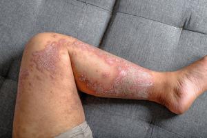 QRX003 Meets Primary Endpoint in Netherton Syndrome Trial