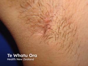 Earlier Biologic Intervention Is Necessary in Moderate to Severe Hidradenitis Suppurativa
