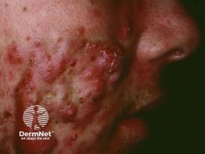 Ultrapulse CO2 Laser Therapy Shows Promise for Chronic Acne Conglobata Sequelae