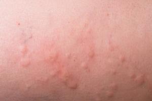 Tezepelumab Shows Sustained Post-Treatment Benefit in Chronic Spontaneous Urticaria Despite Missed Primary Endpoint