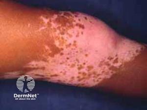 AbbVie Files for Vitiligo Indication, Putting Systemic Therapy Under Regulatory Review
