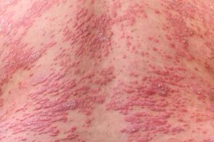 psoriasis