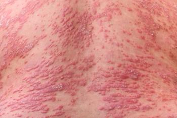Psoriasis