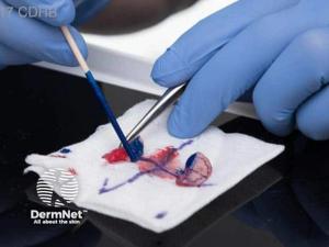 Mohs Micrographic Surgery in High-Profile Patients: A Call for Expanding Access to Skin Cancer Care