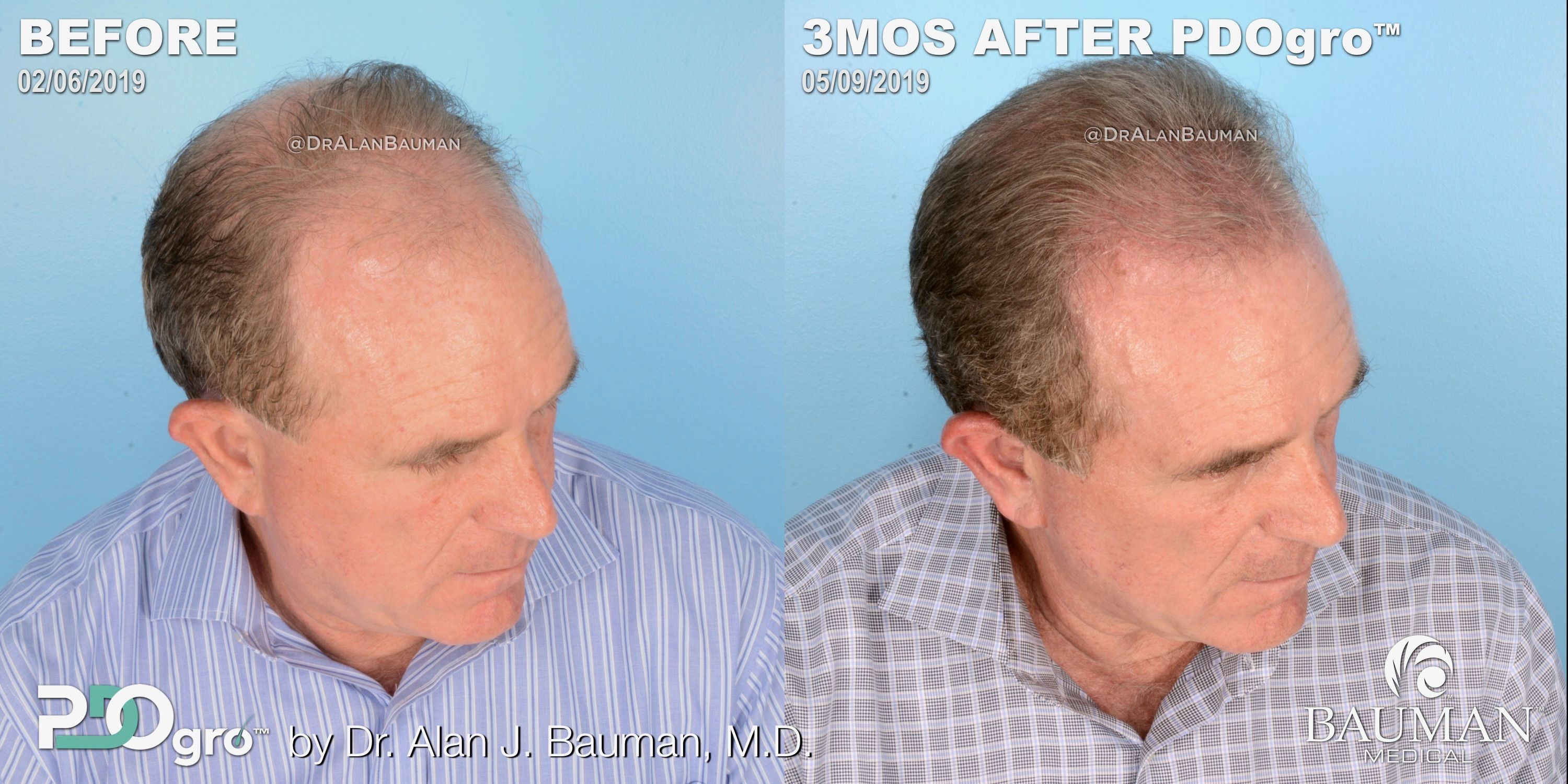 Counter Hair Loss with PDO Threads