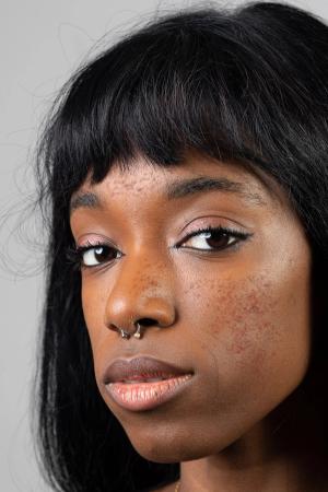 Tips for Improving Rosacea Recognition in Patients With Skin of Color at Elevate-Derm