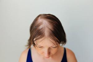 Alopecia Areata Awareness Month: 2026 in Review