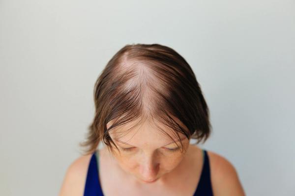 Alopecia Areata Awareness Month: 2026 in Review