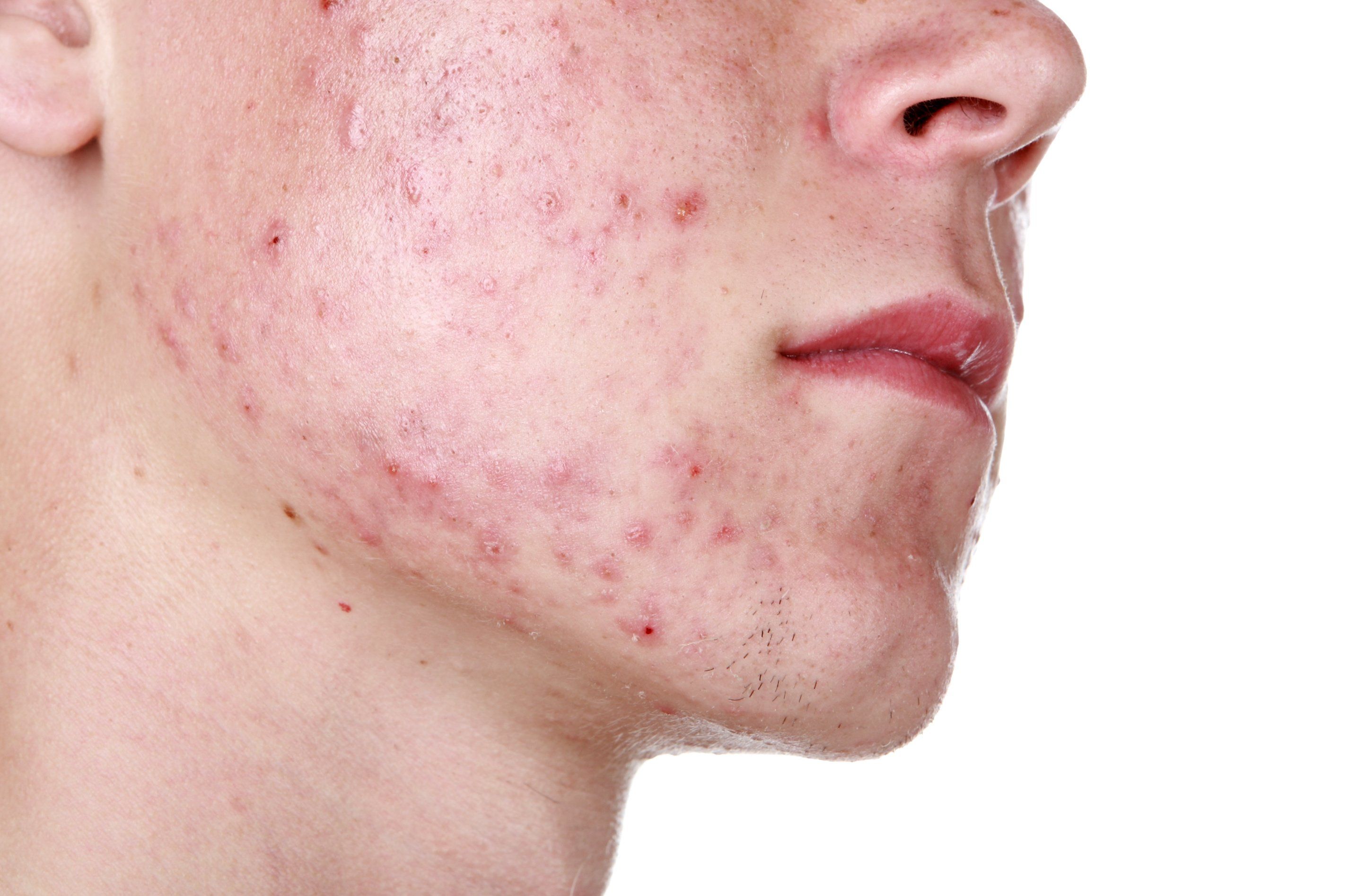 acne causes and practical management pdf download