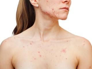 How to Improve Acne Treatment Regimens