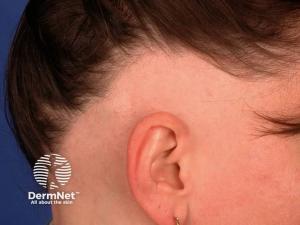 FDA Approves Baricitinib for Adolescents With Severe Alopecia Areata