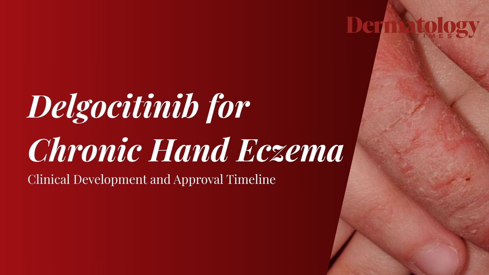 Delgocitinib: Clinical Timeline and Approval