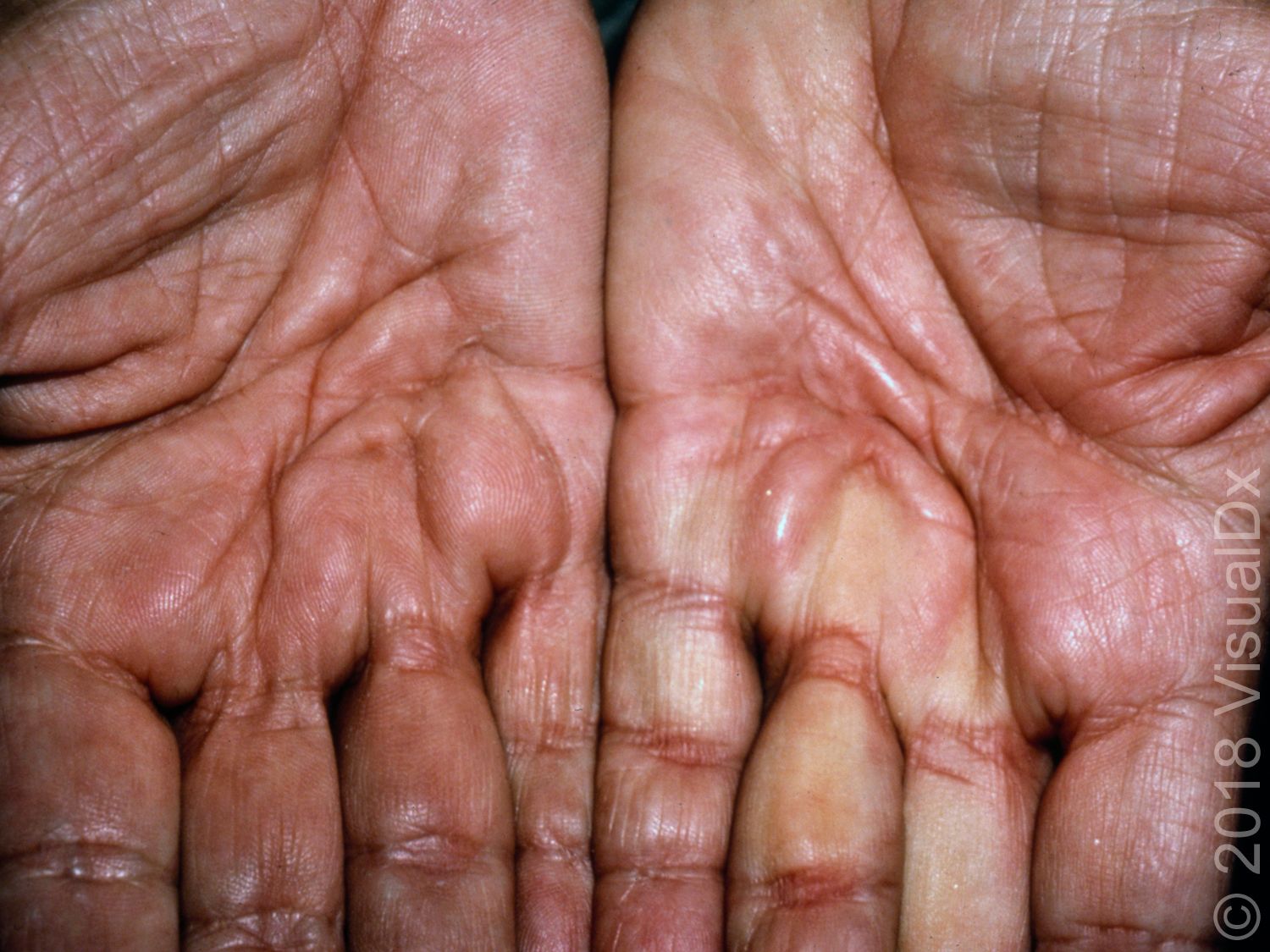 Image IQ:  Hand numbness, pain, skin tightness and raised scars