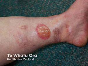 Newly Developed REACH Score Identifies Burden for Employed Patients with Chronic Wounds