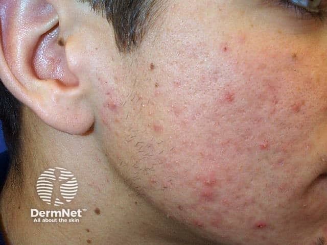 <![CDATA[Dermatologic Effects of Energy and High Protein Drinks]]>