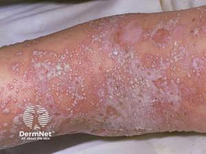 Vanda Files BLA for Imsidolimab in Generalized Pustular Psoriasis