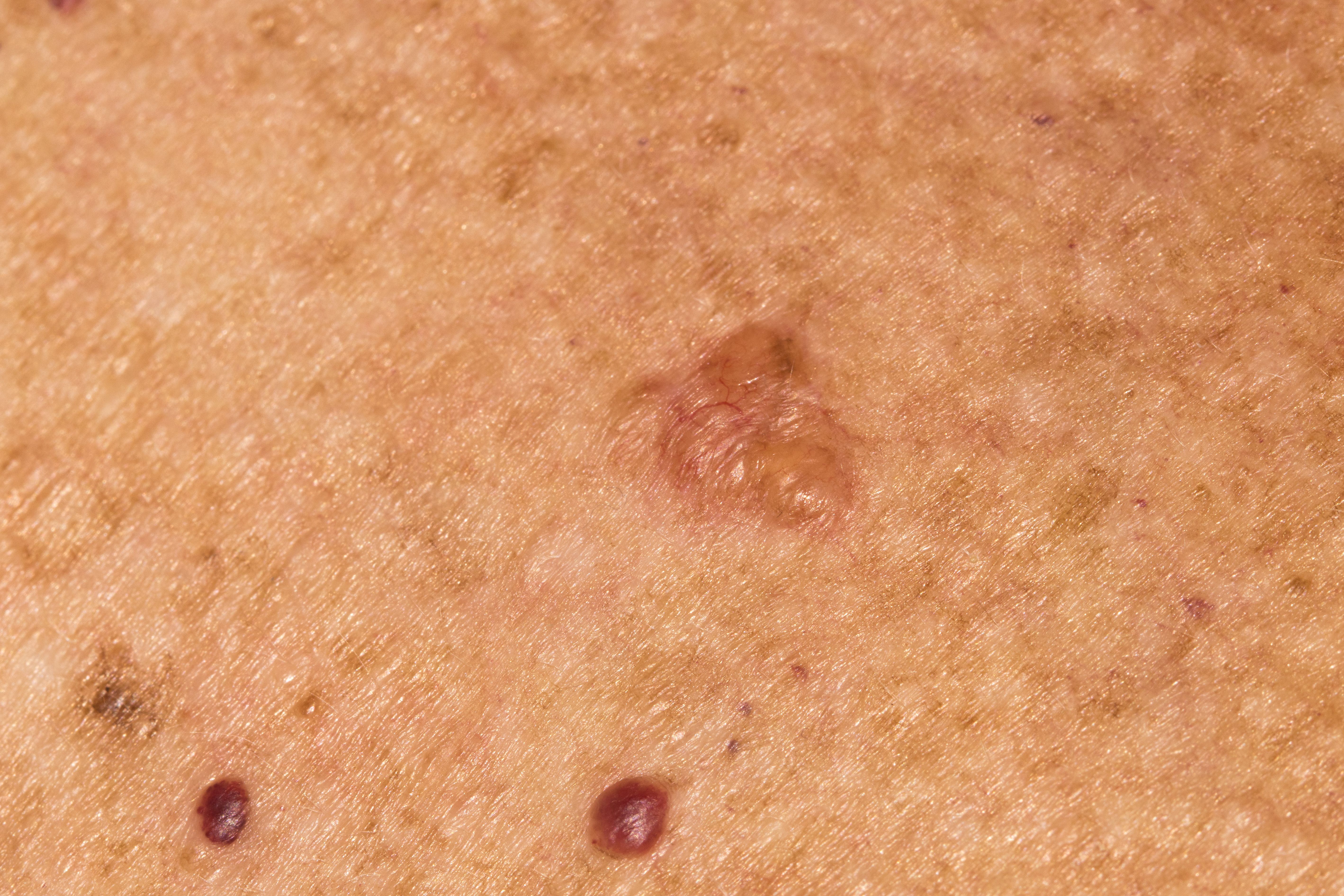 Medicus Moves Forward in UAE Trial for Novel, Non-Invasive BCC Therapy