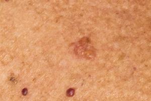 Medicus Moves Forward in UAE Trial for Novel, Non-Invasive BCC Therapy