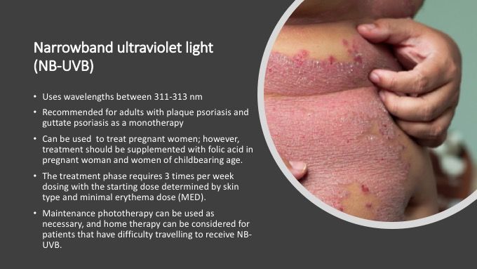 Narrowband ultraviolet light (NB-UVB) 