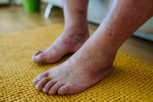 PolarityBio Completes Pivotal Phase 3 Trial of SkinTE for Diabetic Foot Ulcers