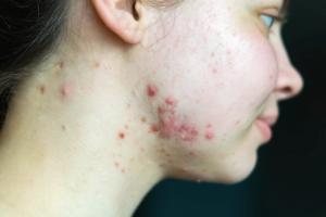 Azithromycin Pulse Therapy Matches Doxycycline Efficacy for Acne with Fewer Adverse Effects