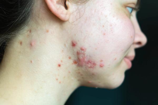 Azithromycin Pulse Therapy Matches Doxycycline Efficacy for Acne with Fewer Adverse Effects