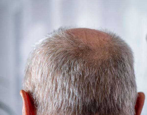 First-in-Class Topical GT20029 Demonstrates Promising Phase 2 Efficacy and Tolerability for AGA