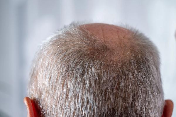 First-in-Class Topical GT20029 Demonstrates Promising Phase 2 Efficacy and Tolerability for AGA