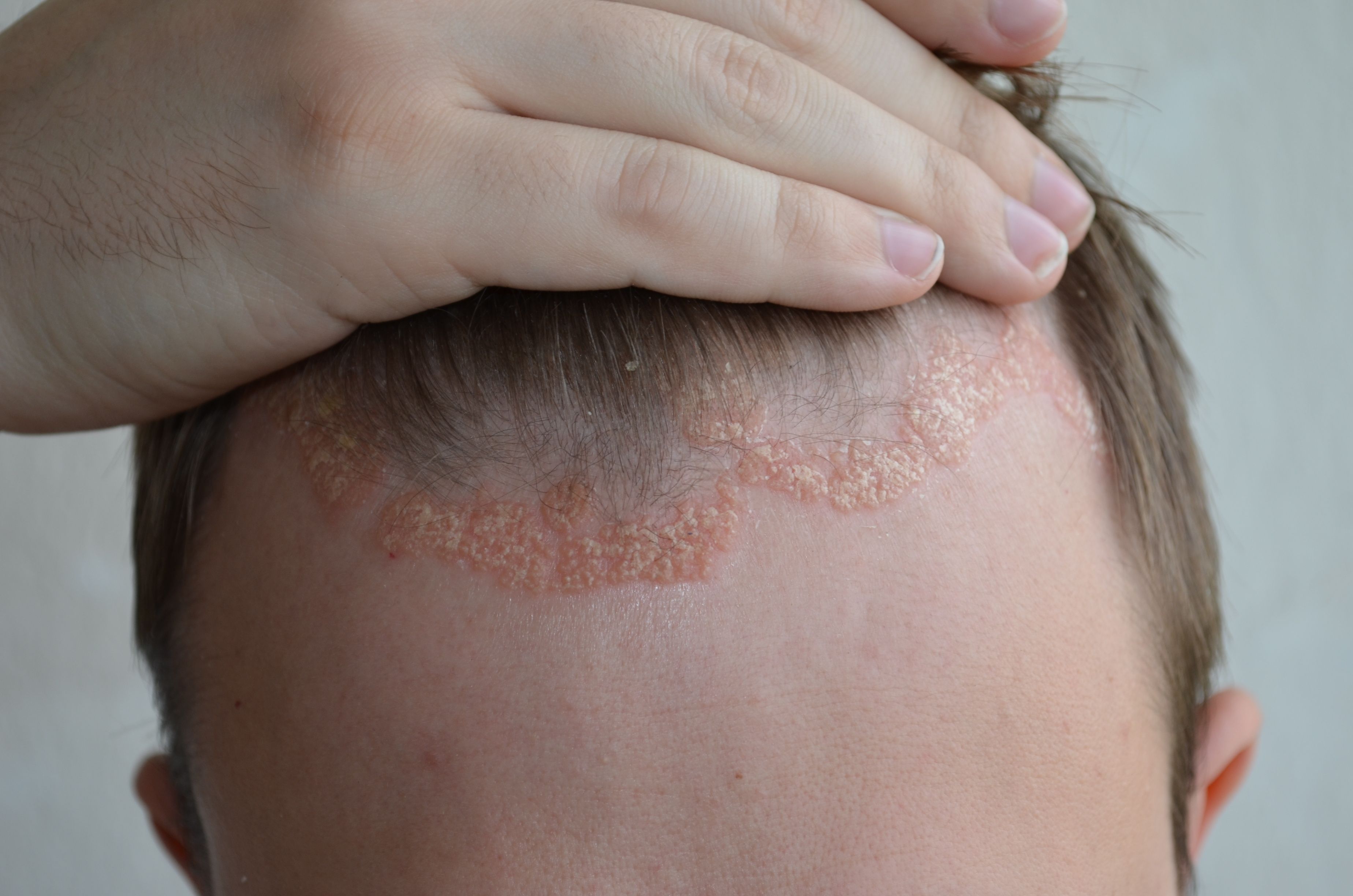 scalp psoriasis