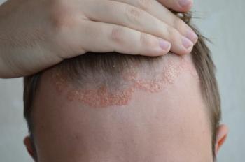 scalp psoriasis