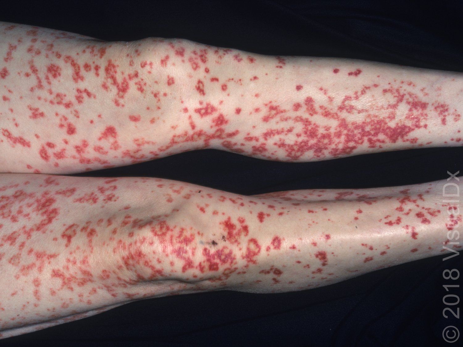Image IQ: A 43-year-old man with a symmetrical palpable purpura rash on his  legs