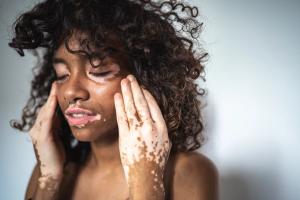 Visible Vitiligo Linked to Significant Stigma and Behavioral Adaptations, According to Global Survey