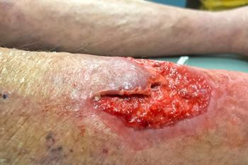 Topical Tranexamic Acid Shows Efficacy for Postoperative Bleeding Reduction