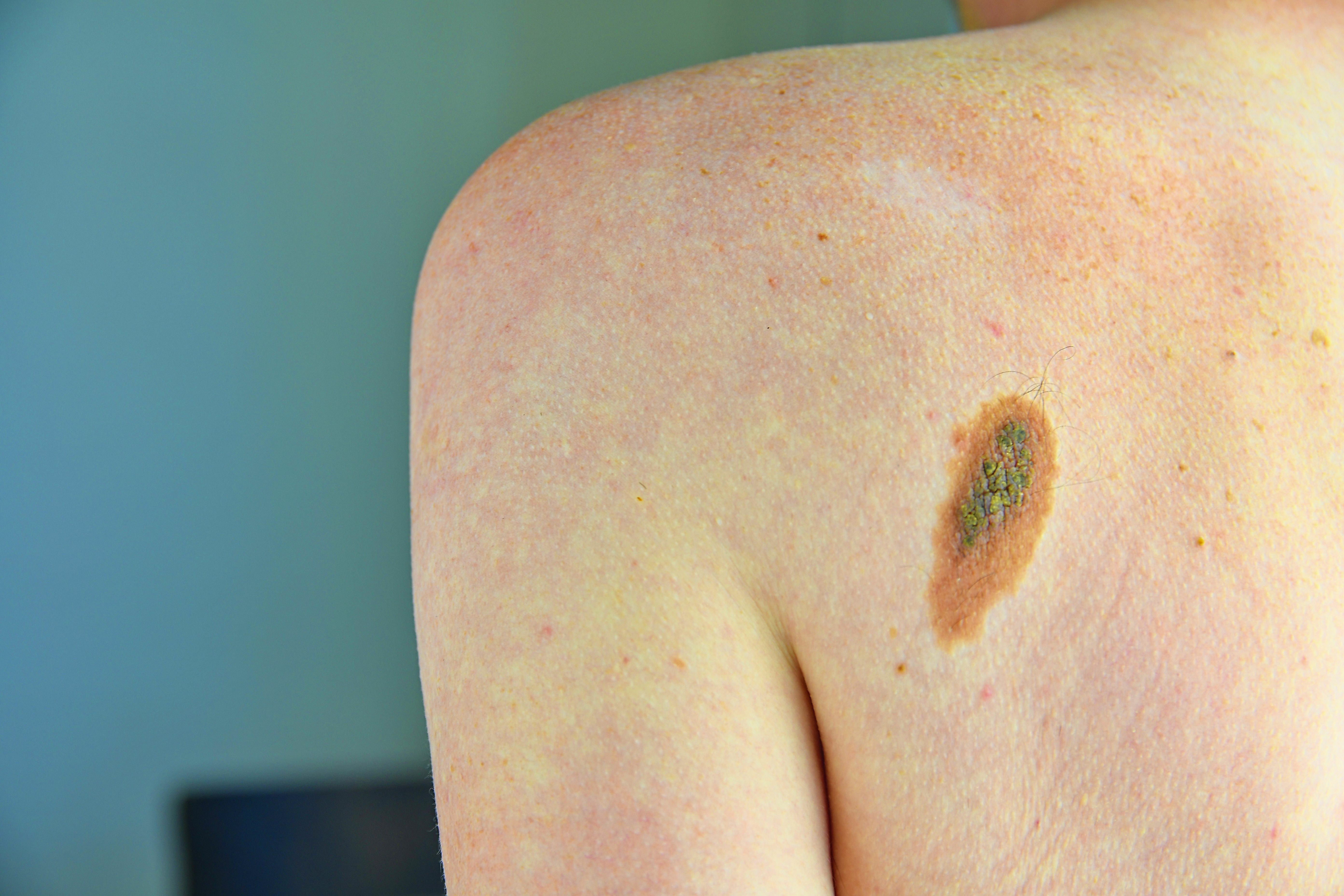 Disadvantages of Excision for Melanoma